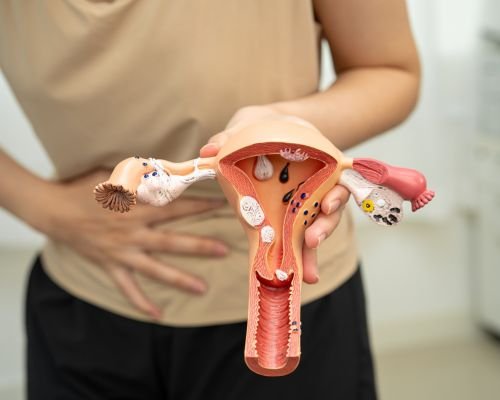 Endometriosis